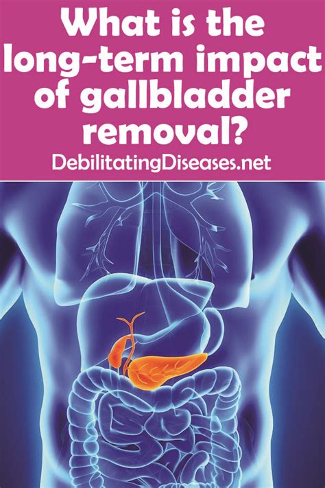 Postcholecystectomy syndrome (PCS) explains the presence of abdominal symptoms two ormore years <b>after</b> a cholecystectomy (<b>gall bladder</b> <b>removal</b>). . Burping months after gallbladder removal